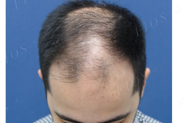 Depois do transplante capilar