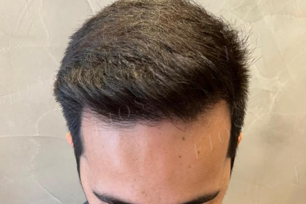 Antes do transplante capilar